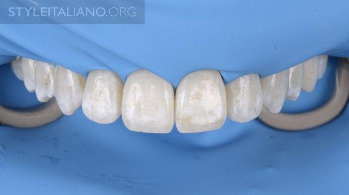 4 External Bleaching was carried out using thermoformed trays and 10% carbamide peroxide gel.