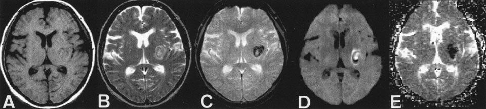 AJNR: 21, August 2000 INTRACRANIAL HEMATOMAS 1193 FIG 2. ADC map in case of hyperacute intracranial hematoma. A, T1-weighted images (600/11/1). Left subinsular hematoma is isointense to brain.