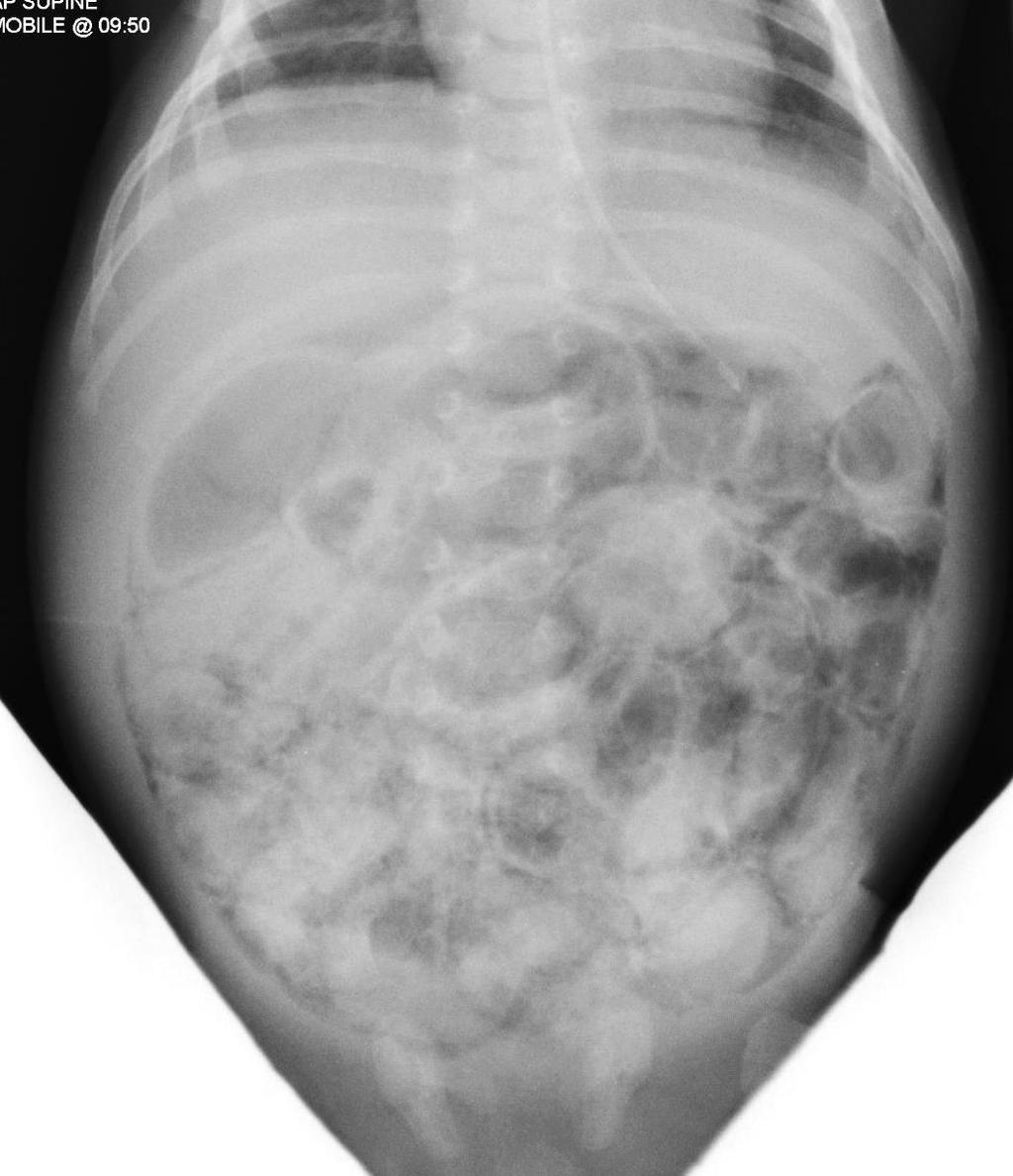 Intramural gas in gastroschisis (pneumatosis intestinalis - PI) Seen in 6 babies at the time that they