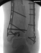 fibula) Medial plate better for varus type fractures (transverse fibula) Oken, OF., et. Al.