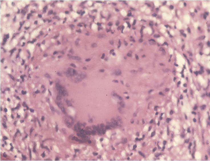 GRANULOMA FORMATION Delayed Type Hypersensitivity Destroy bacilli laden macrophage Caseous Necrosis Very Tissue