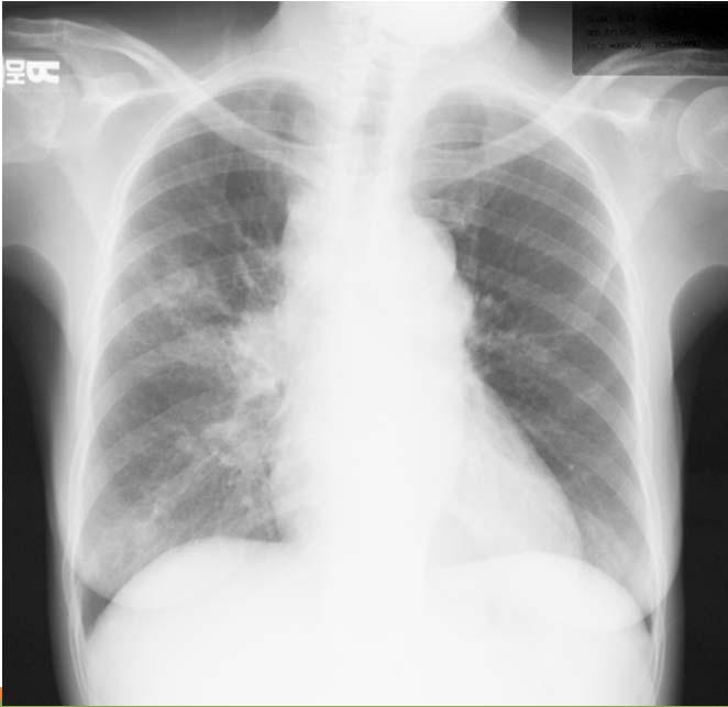 PRIMARY TUBERCULOSIS