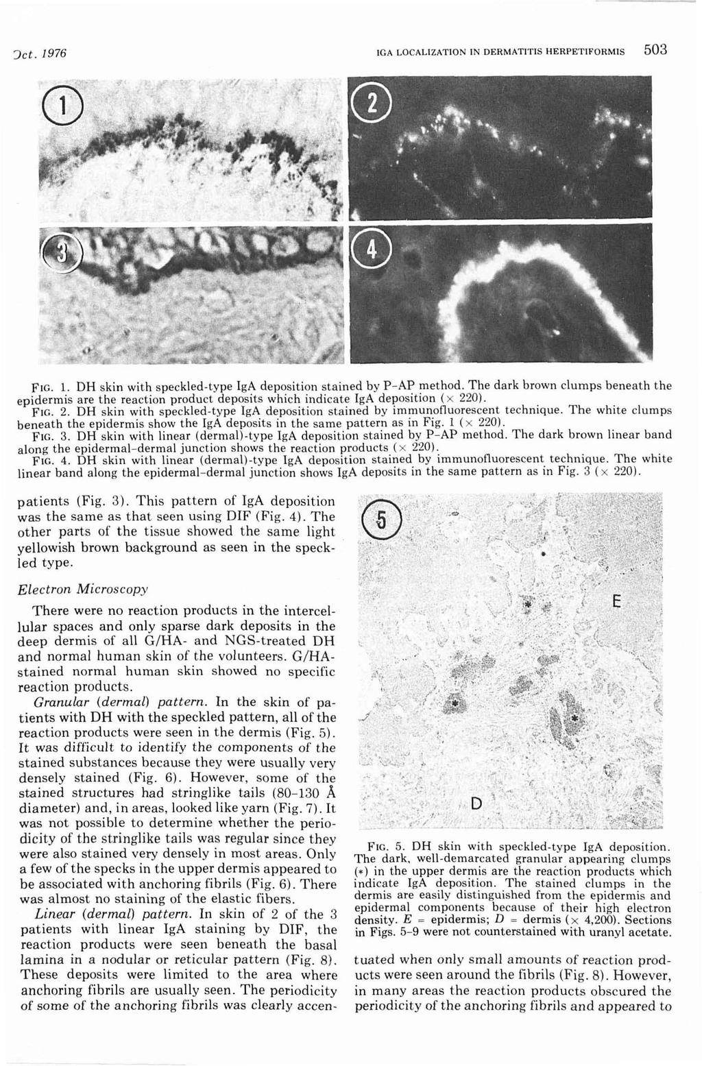 'Jet. 1976 IGA LOCALIZATION IN DERMATITIS HERPETIFORMIS 503 FIG. 1. DH skin with speckled-type IgA deposition stained by P - AP method.