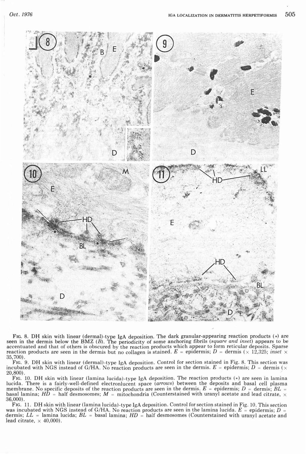 Oct. 1976 IGA LOCALIZATION IN DERMATITIS HERPETIFORM IS 505 FIG. 8. DH skin with linear (dermal) type IgA deposition.