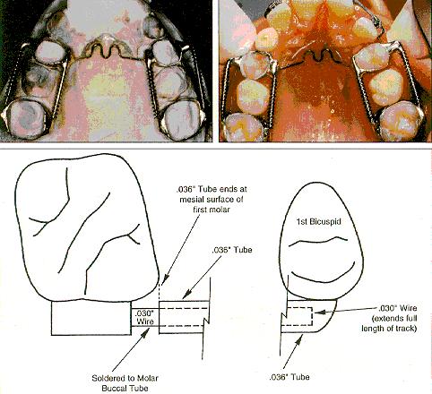 74619 Abdul Baais Akhoon and Syed Zameer. Molar distalization- A review Does not require patient compliance. Reduces treatment time. Maintains arch width after expansion. Light controlled forces. Fig.