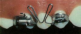 K Loop molar distalizer The wire is marked at the mesial of the molar tube and the distal of the premolar bracket.