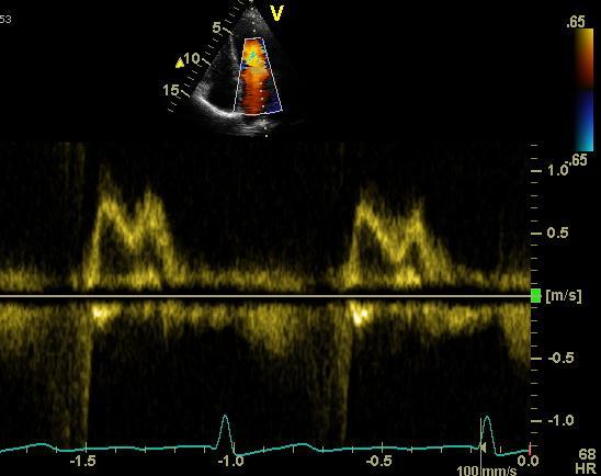 Mitral inflow - limitations U-shaped relation with LV diastolic function