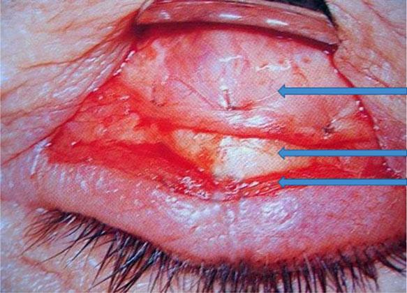 (B) The eyelid is elevated and the Putterman s clamp catches the Muller s muscle and the palpebral conjunctiva. Additional tarsectomy can be included, based on the amount of ptosis. Figure 2.