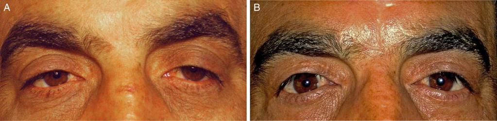 778 Aesthetic Surgery Journal 35(7) Figure 3. (A) A 34-year-old man with left ptosis (marginal reflex distance 1.5 mm in his right eye and 0.5 mm in the left).