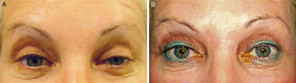 Nemet 779 findings is that the LP muscle is fibrotic and not elastic in cases of traumatic or congenital ptosis.
