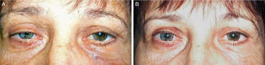 780 Aesthetic Surgery Journal 35(7) Figure 6. (A) A 21-year-old woman with left congenital ptosis (marginal reflex distance 4 mm in right and 1 mm in the left eye).
