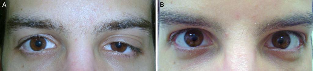 (A) A 50-year-old woman with right congenital Horner s syndrome. Note the characteristic iris heterochromia (the iris of the affected eye is lighter in color than that of the unaffected eye).