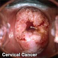 Cervical cancer HPV Testing We can now determine whether women carry high risk HPV types.