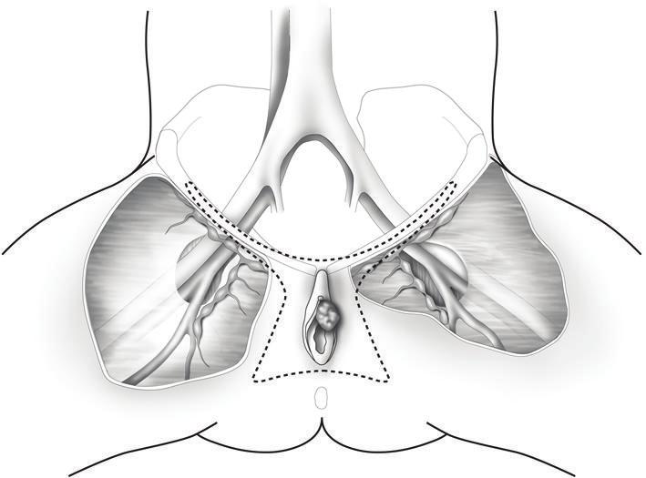 2 International Journal of Surgical Oncology (a) (b) Figure 1: Lateral vulvar lesions >1 cm from the midline (a) spread initially to the ipsilateral superficial inguinal lymph nodes, whereas midline