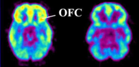 Decreases in Metabolism in Orbito Frontal Cortex (OFC) Compromise assigning