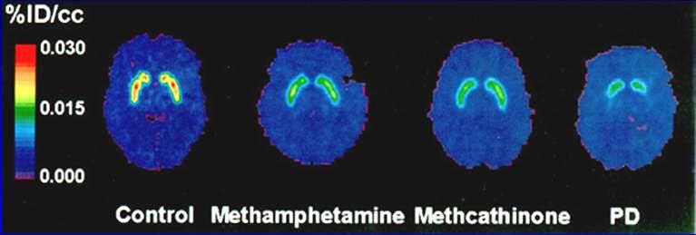 METH Suppresses Expression of DAT (note: duration of use/3-20 yrs; abstinent/ 1-4 yrs)