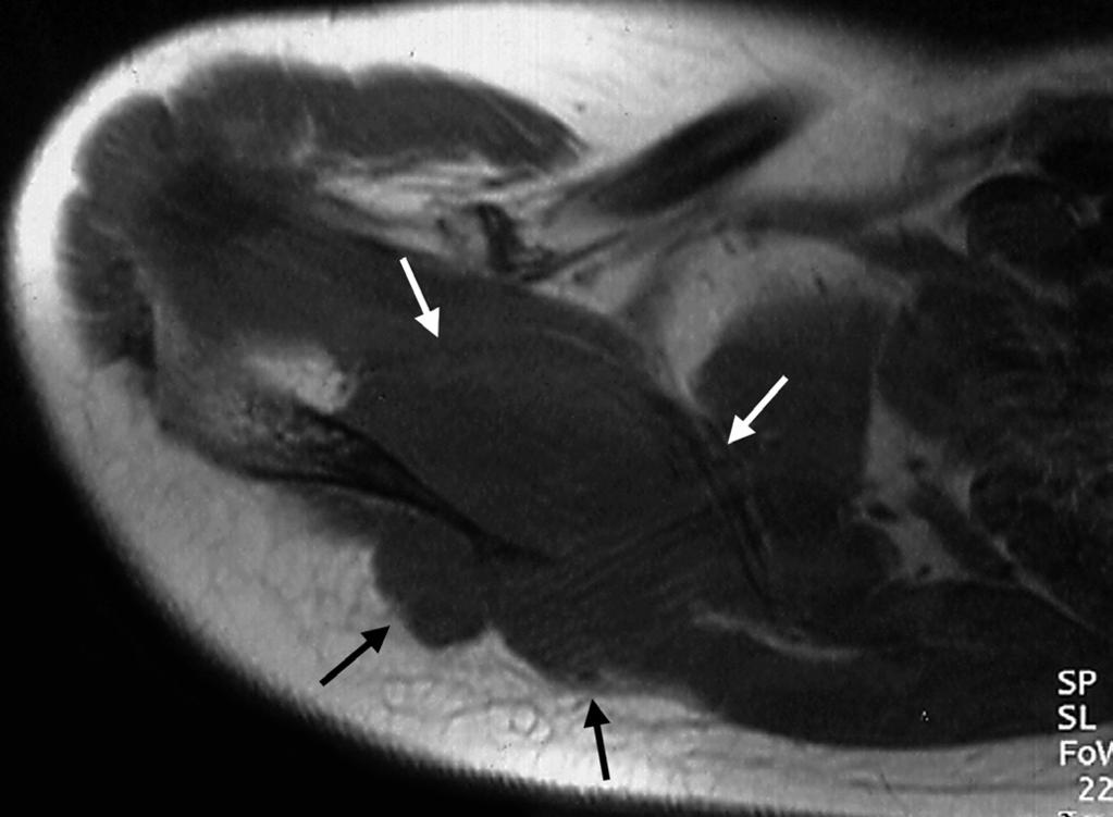 Hong et al. rib with medullary infiltration (Fig. 1D).