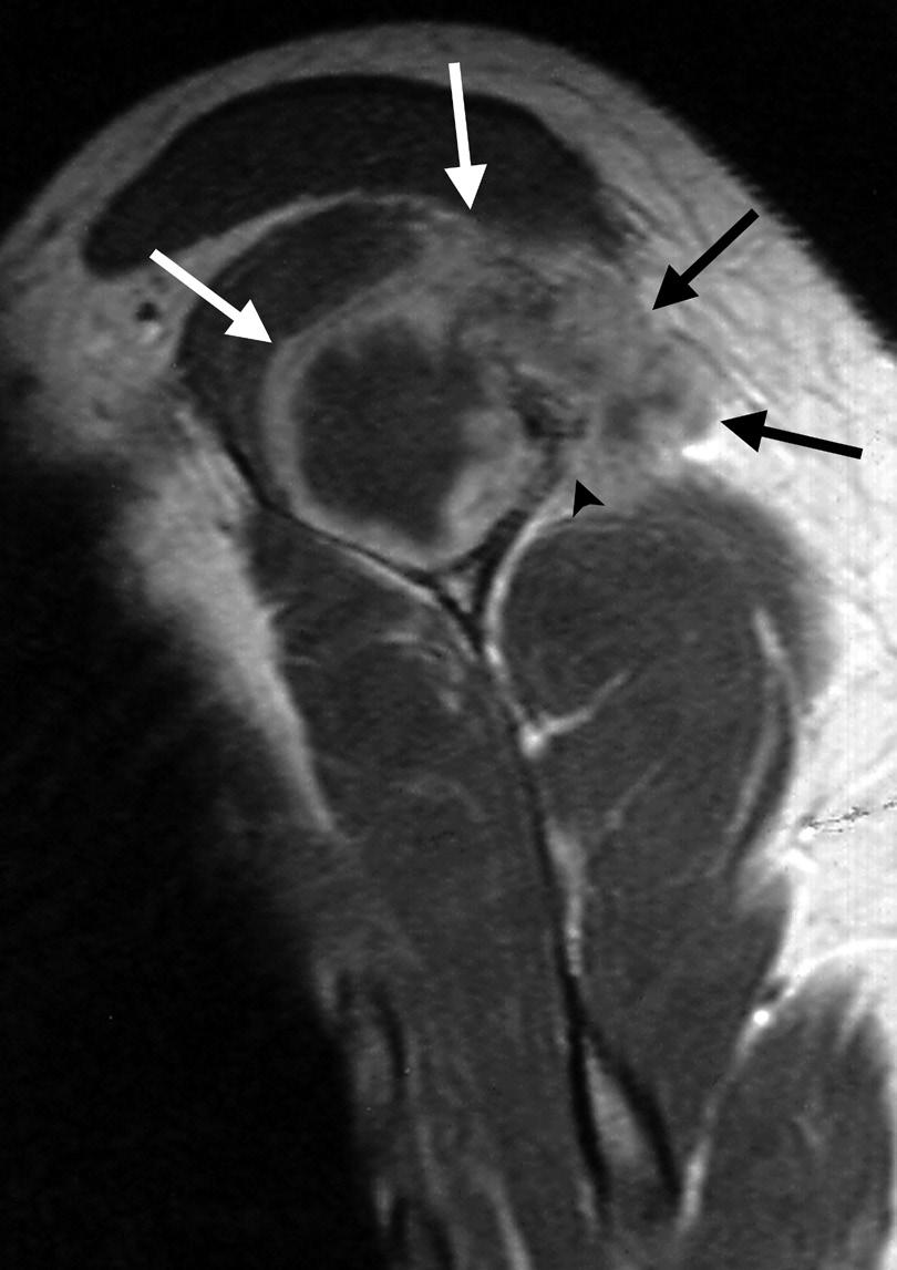 Axial scan of fat-saturated and contrast-enhanced T1-weighted image shows rim enhancement of mass (arrows). D.