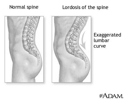 Lordosis An increase in the