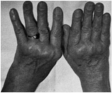 Rheumatoid arthritis Etiology/pathophysiology Autoimmune disorder, but may also be genetic Chronic inflammation of the joints Slide 4 Rheumatoid arthritis Clinical manifestations Characterized by