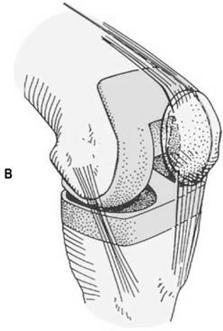 arthroplasty (total hip replacement) Replacement of the hip joint Slide 22 Figure 44-11 (From Phipps, W.J.