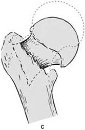 leg voluntarily Slide 25 Figure 44-16 Fractures of the hip.