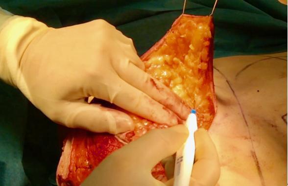 Elevation of the medial flap of the skin envelope, with assistant retracting away from the chest using skin hooks The lateral flap is raised in the same way and at the same thickness, again not