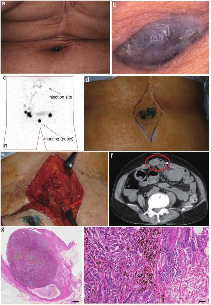 S. Suzuki et al. Fig. 1. Clinical and operative view, image study, and histopathology. a: A pigmented nodule of 2 1 in the umbilicus. b: The umbilicus was filled with the nodule.