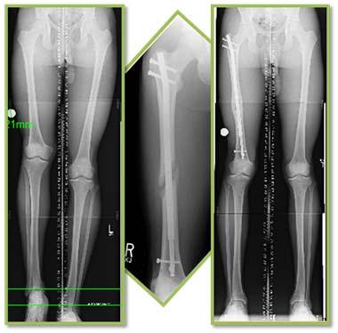 LAST ONE 16 yr old male had a history of osteomyelitis of his right distal femur at age 11.