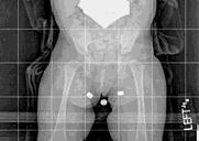 CASE PRESENTATION CC: limb length discrepancy HPI: 15 month old female presents for initial consultation