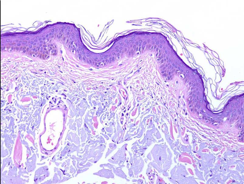 Features that point to melanoma in situ over actinic melanocytosis : Irregular intervals between melanocytes Nests may be present (but sometimes levels needed to show them) Pagetoid spread may be