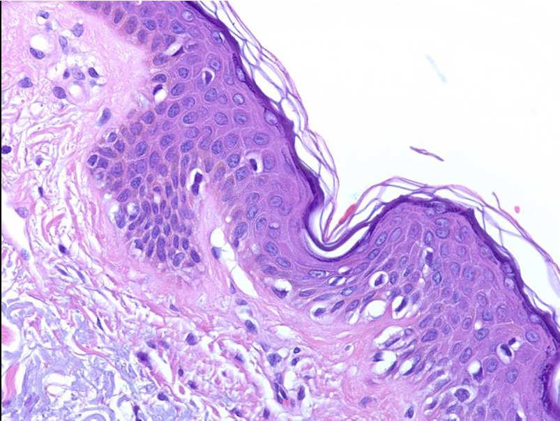 Biopsy of the contralateral side? Hendi, A. et al.