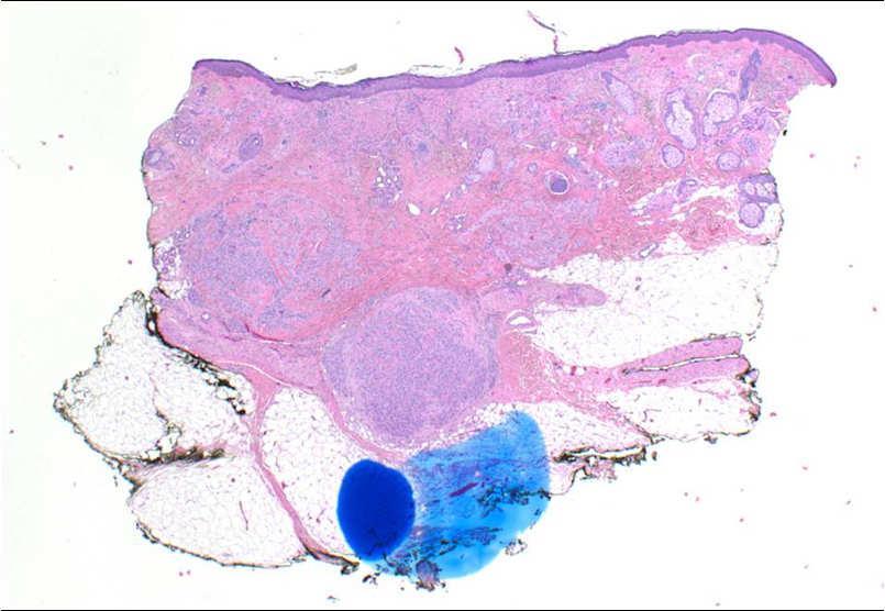 dermatofibrosarcoma protuberans Pigmented basal and sqaumous cell carcinoma Pigmented matricoma
