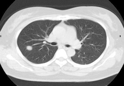 3. Lung cancer screening using CT scanning The examination for lung cancer uses CT scanner.