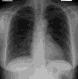 A Chest CT image is better to detect the same lesion, and its location also can be identified accurately. Fig.