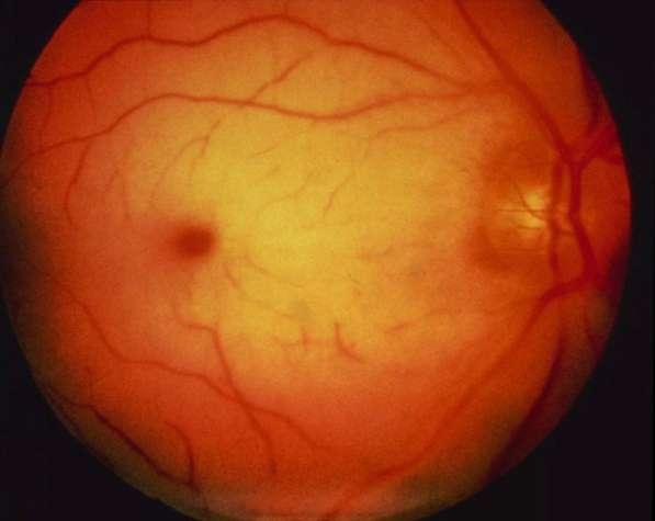 Eyes: loss of vision Retinal artery occlusion Painless