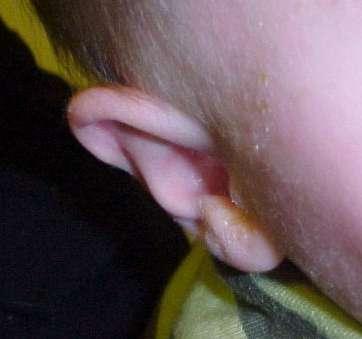 Ears: Otitis Externa 1-2 days of progressive ear pain Symptoms may include Pruritus within the ear canal