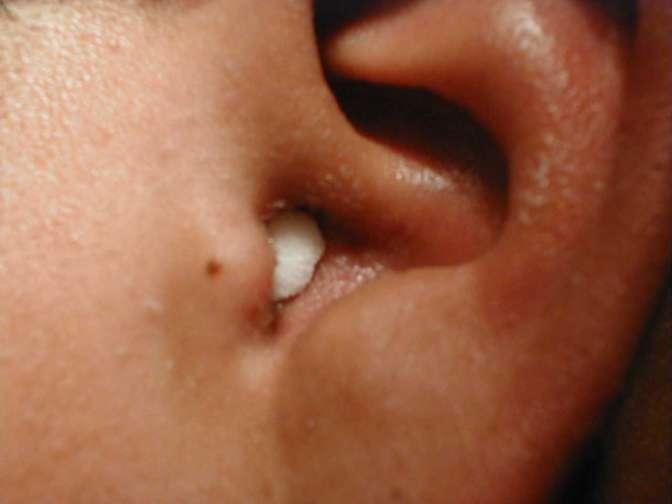 pain on gentle traction of the external ear Erythema, oedema, and narrowing of the external auditory canal