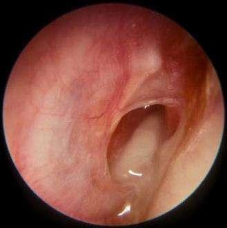 Ears: tympanic perforation Most will heal without intervention Consider