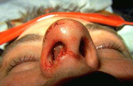 MaxFax: Nasal fractures Obvious deformity Palpate for deformities/tenderness Cerebrospinal fluid rhinorrhoea Look