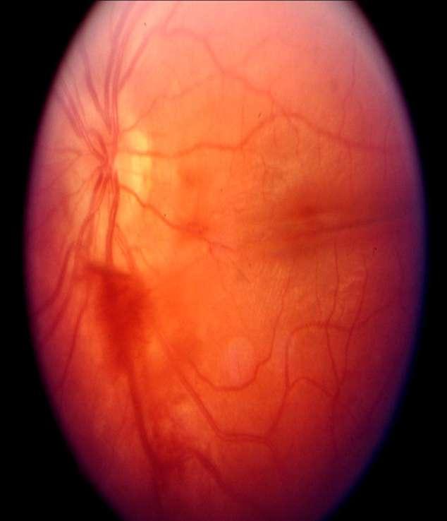 Eyes: acute loss of vision Vitreous haemorrhage Complains of new multiple floaters,