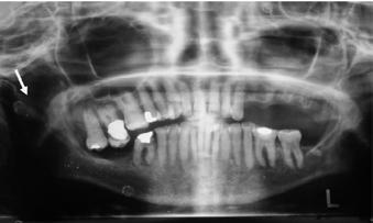 moderate attrition. Deep restorations were present in 14, 17, 36, 46 with periapical lesions. 24, 25, 26, 27, 28, 38, 47, 48 were missing.
