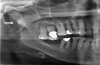 Incidentally, a well formed, impacted tooth was found in the right subcondylar region of the mandible. The tooth crown seemed directed into the head of the condyle [Fig.