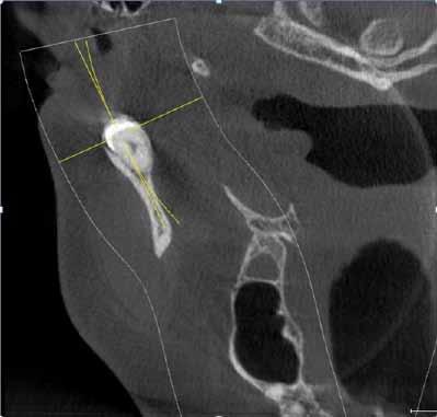 Fig.4: Axial CBCT image. Fig.