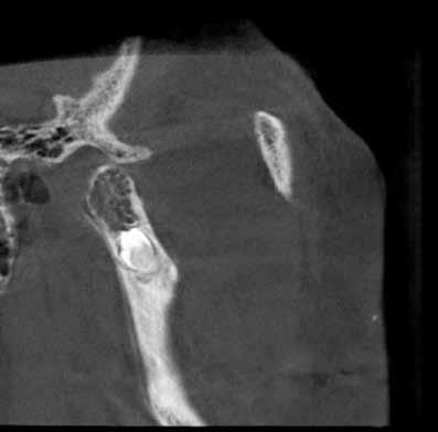 5: Sagittal CBCT image shows the fully developed impacted tooth with the proximity to
