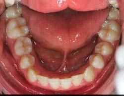 incisors) - Ectopic upper right canine and impacted lower left second premolar Treatment plan -Fixed