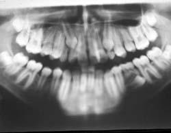 premolar and orthodontic traction -Expansion of the maxillary dental arch length by quad helix