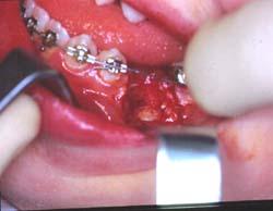 molar (Fig 9).