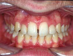 arch (permanent canines are bigger than deciduous ones),anatomic obstructions may involve the fabrication of auxiliaries during the traction process (5).