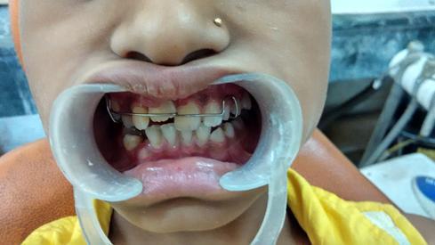 constant irritation from incisal edge, the hypertrophied labial mucosa also healed.